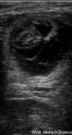 ultrazvukový obraz cca 30. dne březosti